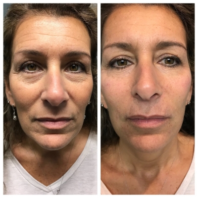Before and after dermal filler for nasolabial folds and lip enhancement, side profile.
