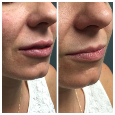 Before and after facial rejuvenation showing smoother forehead lines, crow’s feet, and nasolabial folds.