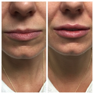 Before and after skin treatment for facial redness and more even tone.