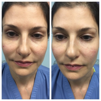 Before and after under-eye and mid-face rejuvenation with softer nasolabial folds.