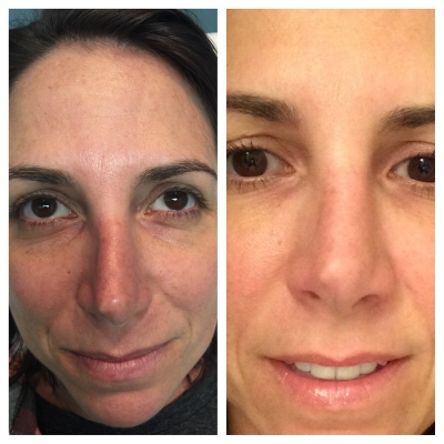Before and after lip filler with improved volume and definition.