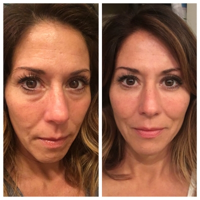 Before and after under-eye area with reduced bags and dark circles.