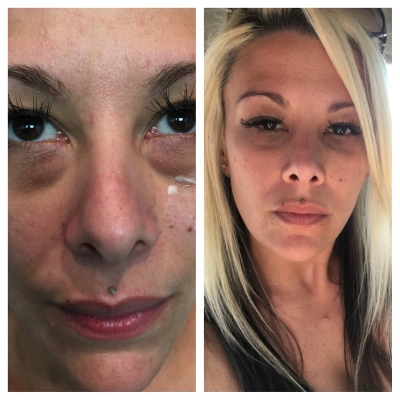 Before and after full-face rejuvenation: forehead, under eyes, and nasolabial folds.