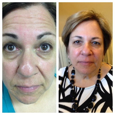 Before and after lip enhancement and softened lines around the mouth.