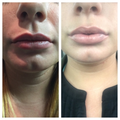Before and after lip filler with fuller, more defined lips.