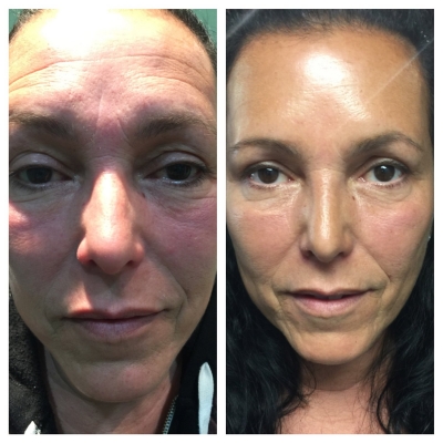 Before and after facial rejuvenation with smoother forehead and mid-face.