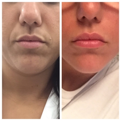 Before and after improvement in sun damage, freckling, and facial lines.