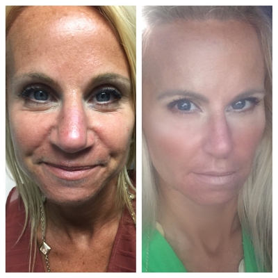 Before and after mid-face rejuvenation with softer nasolabial folds and brighter under-eyes.
