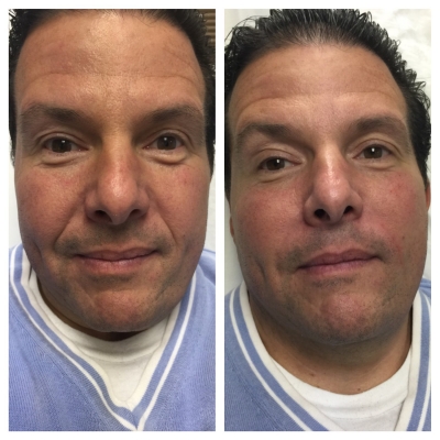 Before and after perioral rejuvenation with smoother lines above the lips.