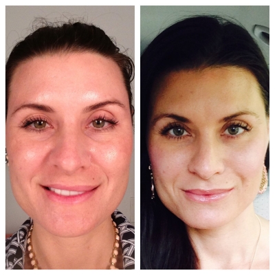Before and after skin rejuvenation with brighter tone and softer wrinkles.