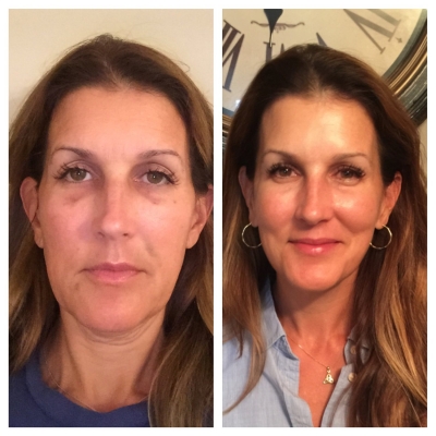 Before and after facial rejuvenation comparison.