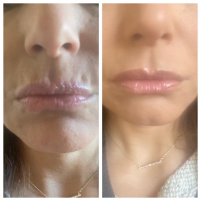 Before and after male facial rejuvenation with softer nasolabial folds and under-eye area.